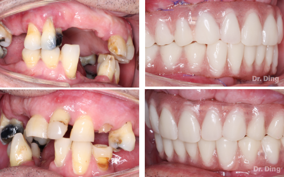 dental implants case in huangshan clinic China