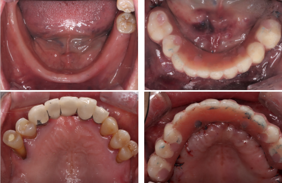 all-on-6 dental implants
