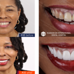 E-Max Veneers before-and-after case in Huangshan Dental Clinic