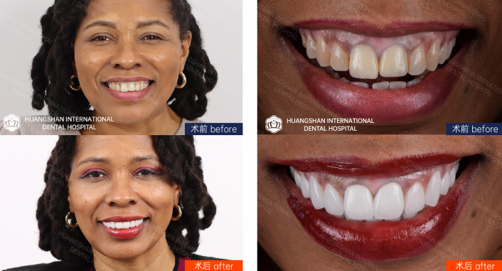 E-Max Veneers before-and-after case in Huangshan Dental Clinic