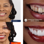 E-Max Veneers before-and-after case in Huangshan Dental Clinic