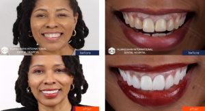 E-Max Veneers before-and-after case in Huangshan Dental Clinic