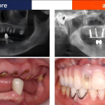 all-on-6 dental implants in China