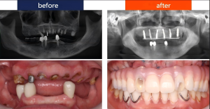 all-on-6 dental implants in China
