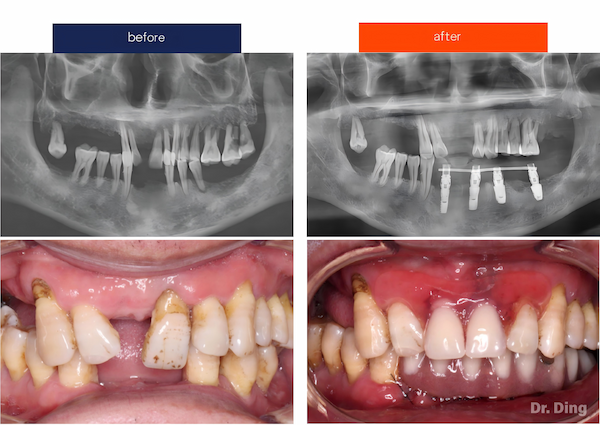 dental implant restoration case before and after