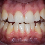 orthodontic relapse after braces