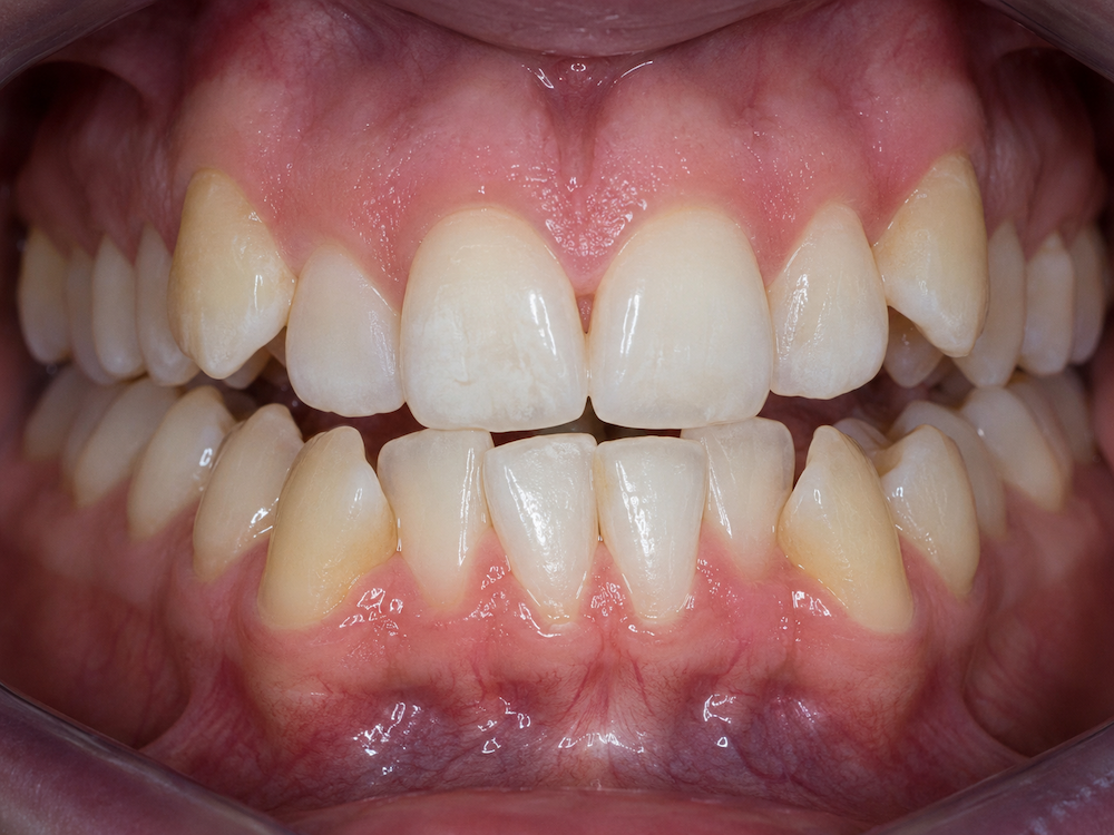 orthodontic relapse after braces