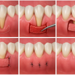Mucogingival surgery