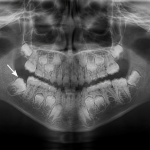 impacted teeth in children