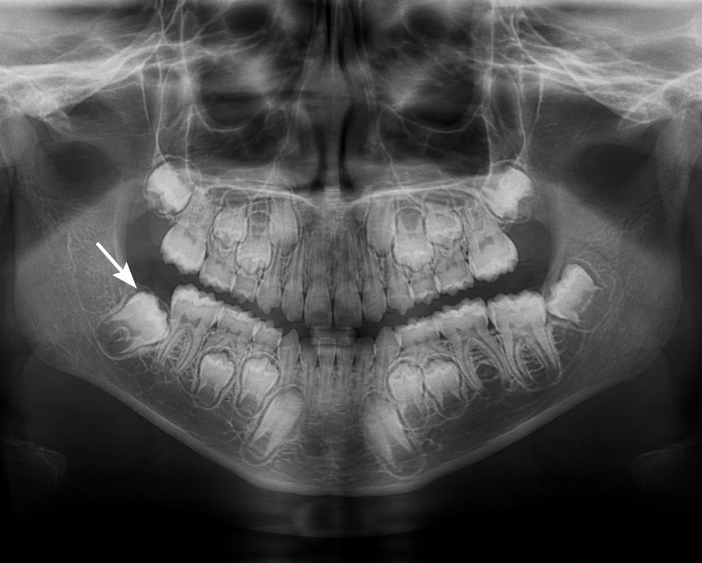 impacted teeth in children