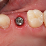 dental implant failure signs
