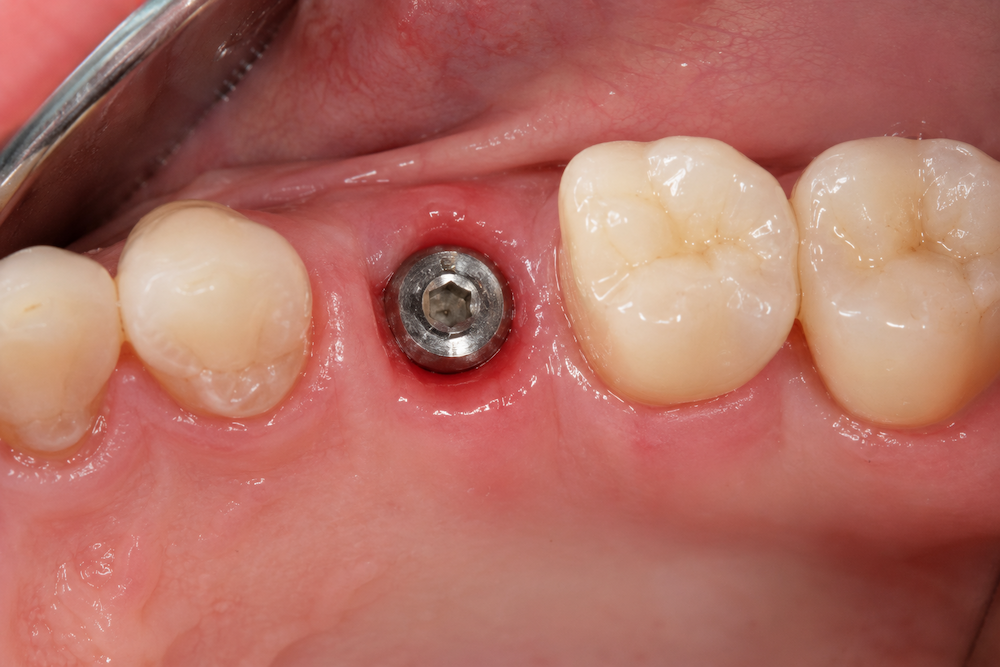 dental implant failure signs