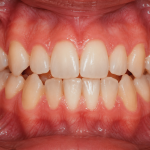 orthodontic relapse after braces
