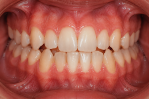 orthodontic relapse after braces