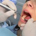 dental filling for cavities