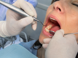 dental filling for cavities