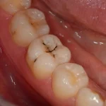 black lines on teeth