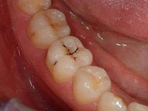 black lines on teeth