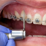 interproximal reduction
