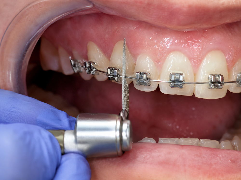 interproximal reduction