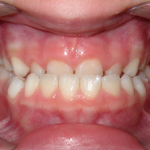 underbite in children