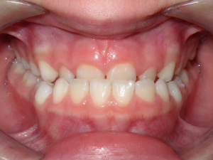 underbite in children