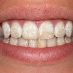 dental fluorosis