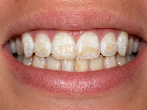dental fluorosis