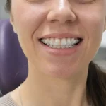 adult teeth straightening