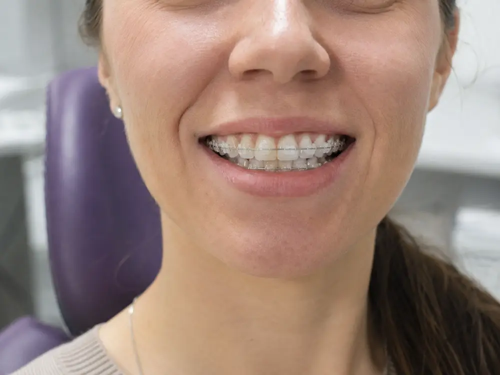 adult teeth straightening