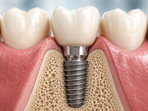 osseointegration dental implant