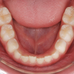 6-year molars