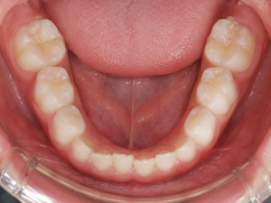 6-year molars