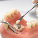 bone graft for dental implant