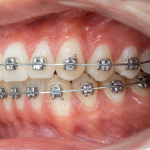 orthodontic archwire