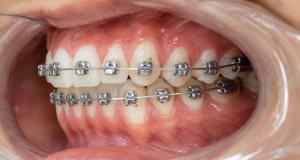 orthodontic archwire