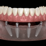 All-on-4 dental implants