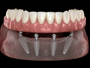 All-on-4 dental implants