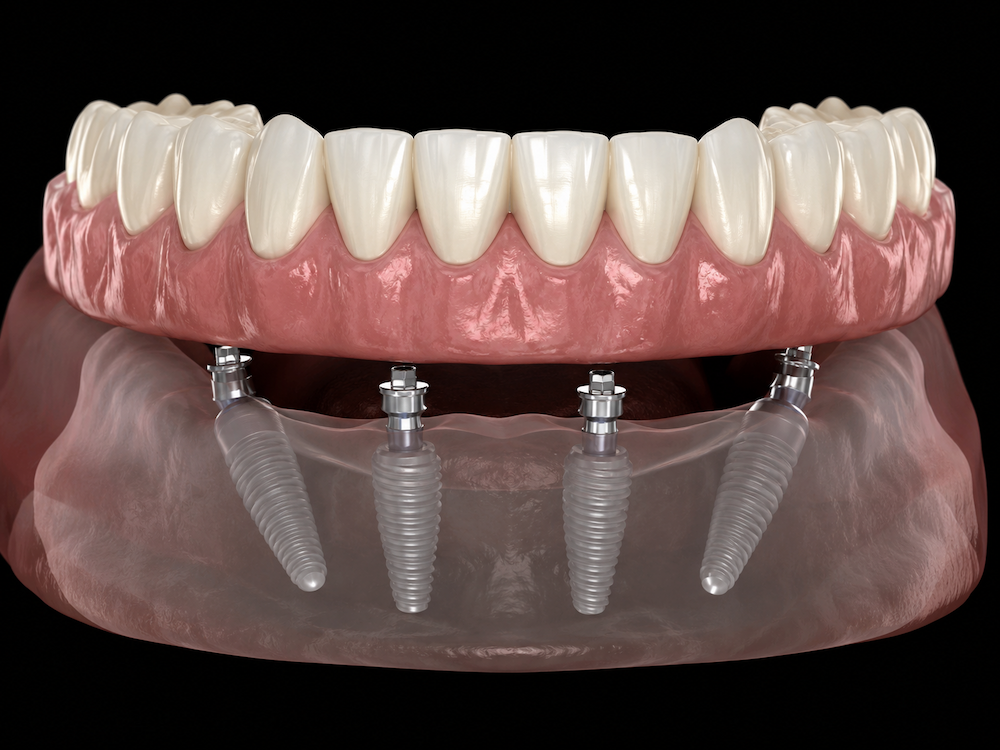 All-on-4 dental implants