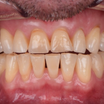 wedge-shaped defect
