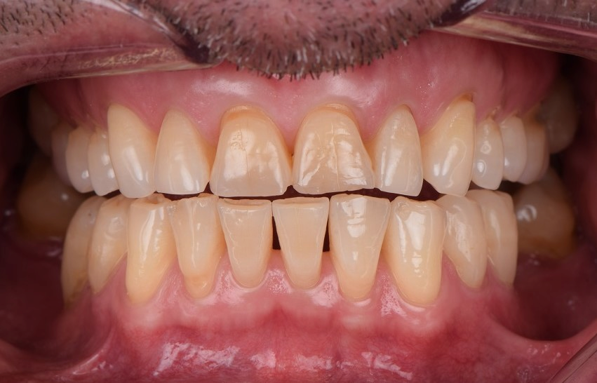 wedge-shaped defect