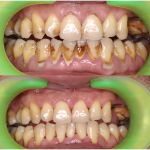 dental calculus removal case