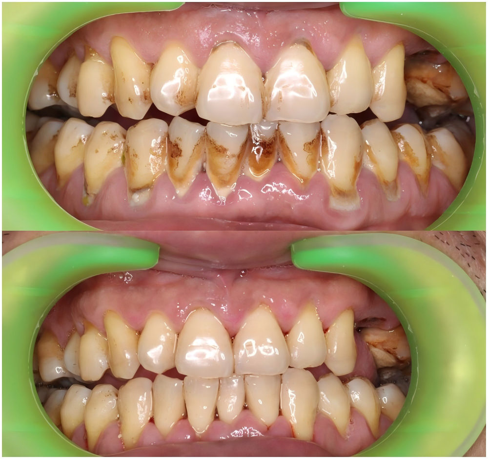 dental calculus removal case