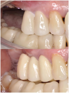 dental implants case
