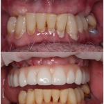 full mouth dental implants for missing teeth