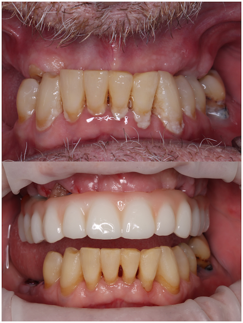 full mouth dental implants for missing teeth