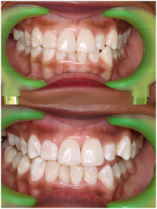 laser whitening in huangshan dental