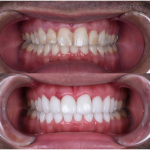 porcelain veneers smile makeover case