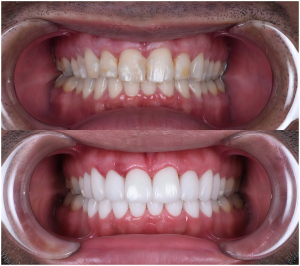 porcelain veneers smile makeover case