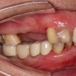 long missing teeth